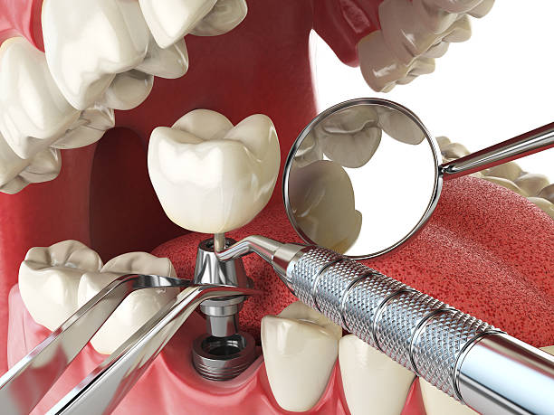 Best Emergency Root Canal Treatment in Chappaqua, NY